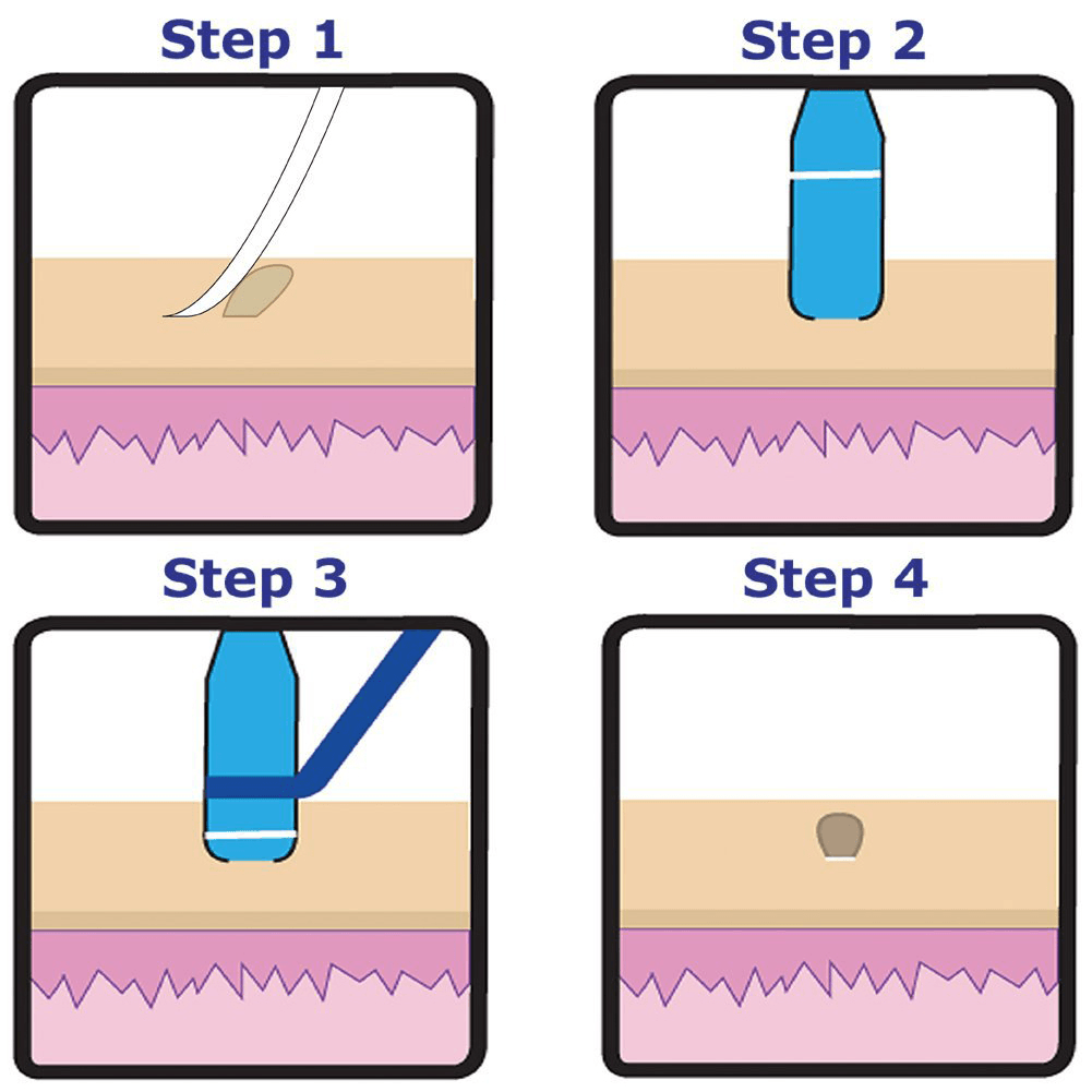 Auto Band Skin Tag Remover Kits Gesichtspflege Schönheitswerkzeuge Warze entfernen Akne Pickel Schönheitsbehandlungen mit 10 Gummibändern